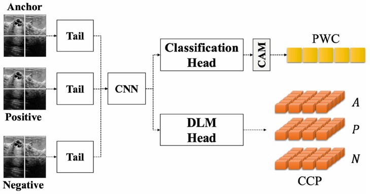 Outlier Robust Disease Classification via Stochastic Confidence Network